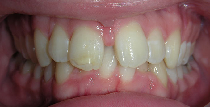 Before treatment for severely retrusive lower jaw